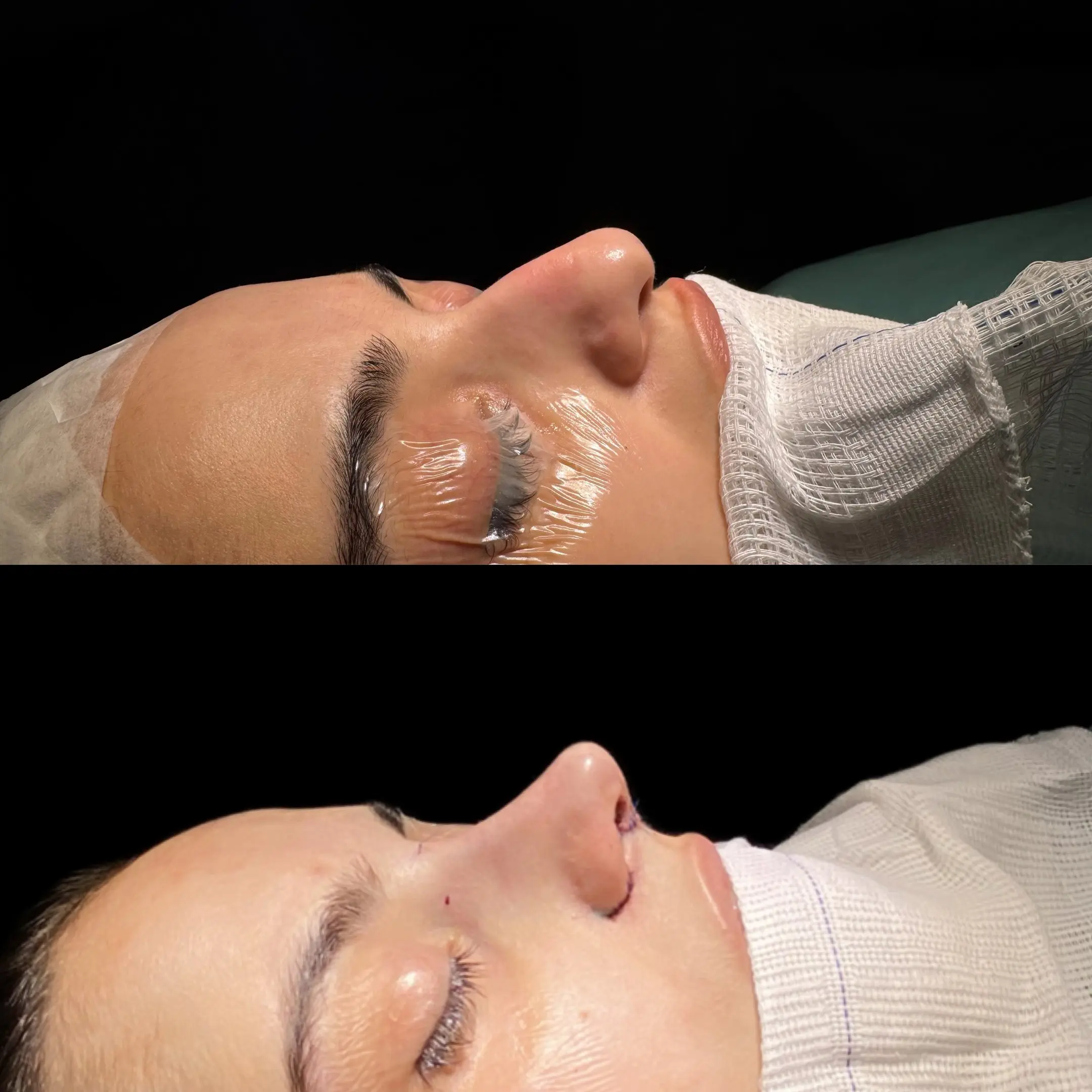 Rinoplastia Estruturada - Vista Frontal